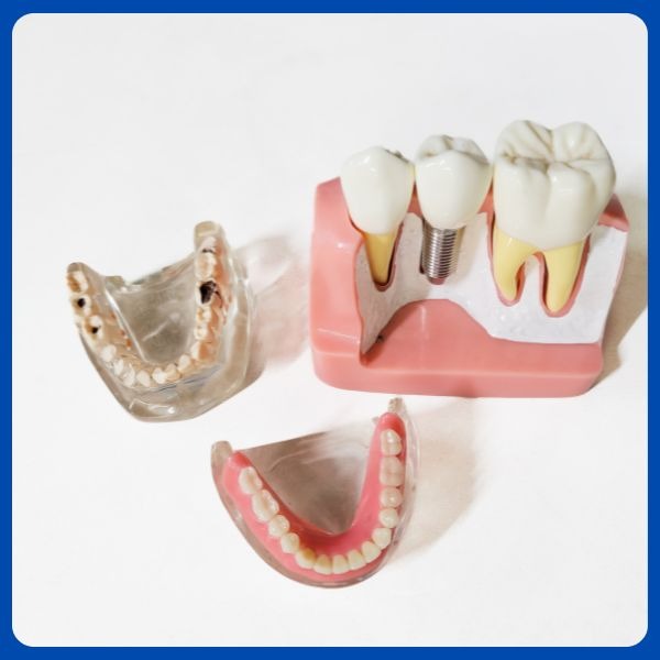 Dental implants treatment in Dubai by experienced implantologist