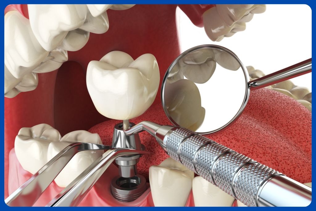 Implant dentures in Dubai for full mouth tooth replacement
